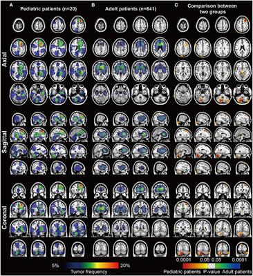 Immune Checkpoint-Associated Locations of Diffuse Gliomas Comparing Pediatric With Adult Patients Based on Voxel-Wise Analysis